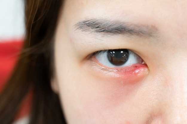 Воспаление ресничных фолликулов - инфекция в области ресниц, вызывающая покраснение и опухание глаза